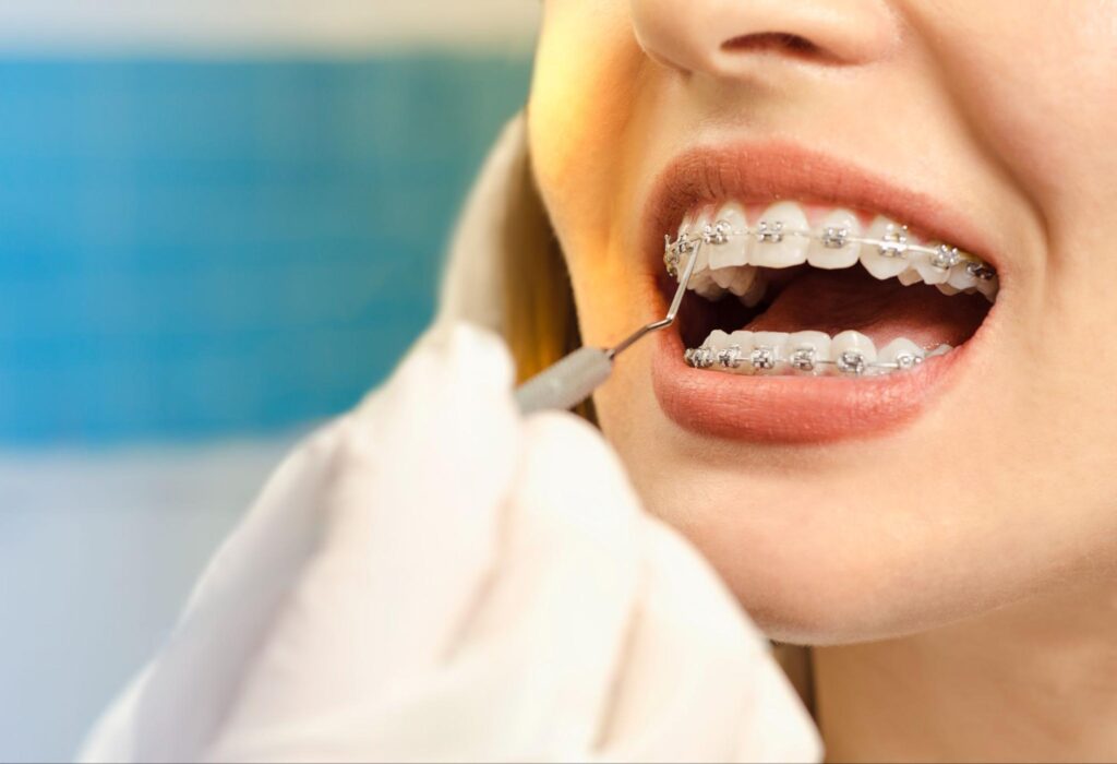 Am I Too Old for Orthodontic Treatment?